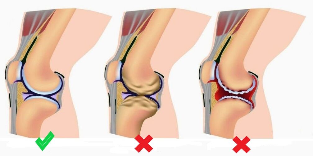 Depanten previene el desarrollo de artritis y artrosis