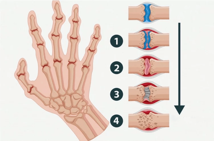 Etapas de la artritis reumatoide que afectan las articulaciones de los dedos. 