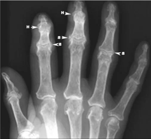 Osteofitos en la osteoartritis de las articulaciones de los dedos en una radiografía