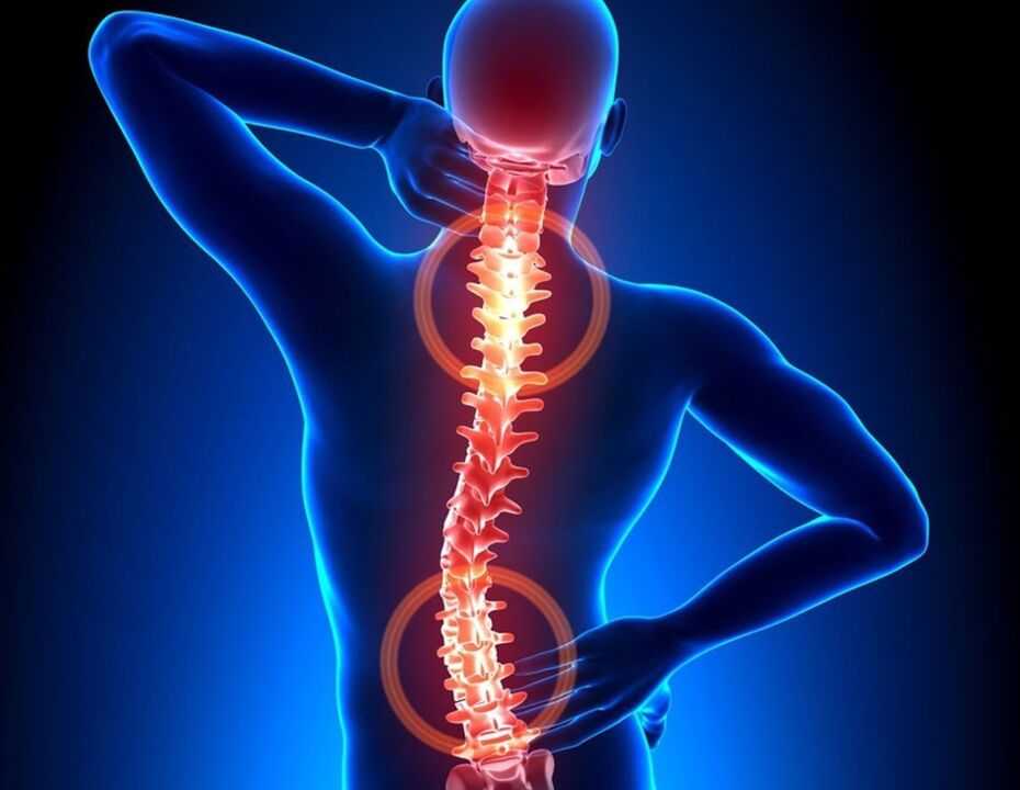 Osteocondritis de la columna