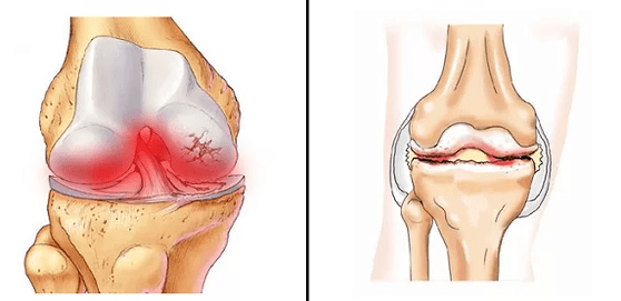 Comparación de artrosis de artritis