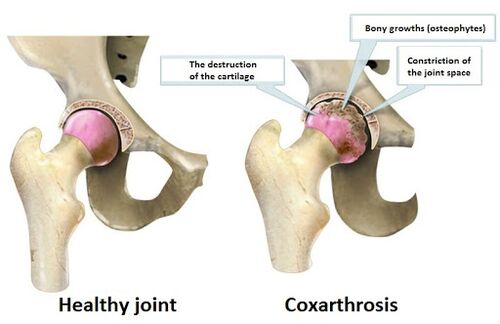Articulación sana afectada por la articulación de la cooksartrosis