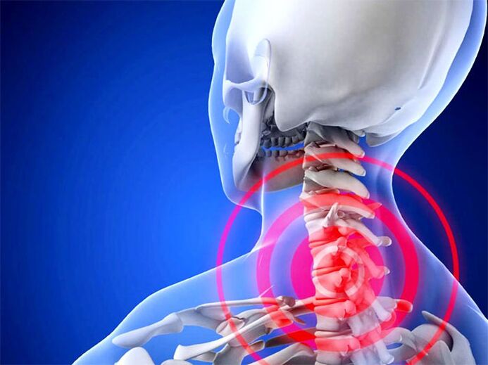 Región cervical inflamada