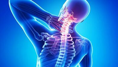 Complicaciones de la osteocondrosis de la columna cervical