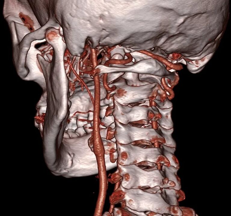 arteria pellizcada con osteocondrosis cervical