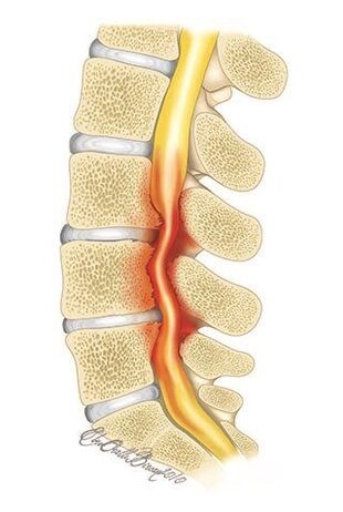 Con la osteocondrosis de la columna torácica, se produce la compresión del canal espinal.