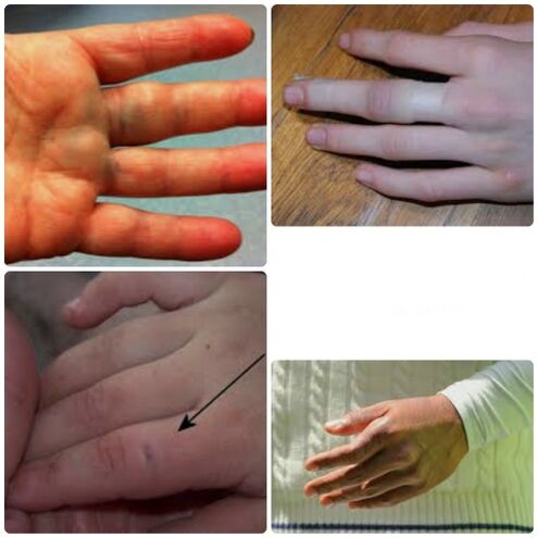 Los hematomas y fracturas de los dedos se caracterizan por dolor e hinchazón en las articulaciones.
