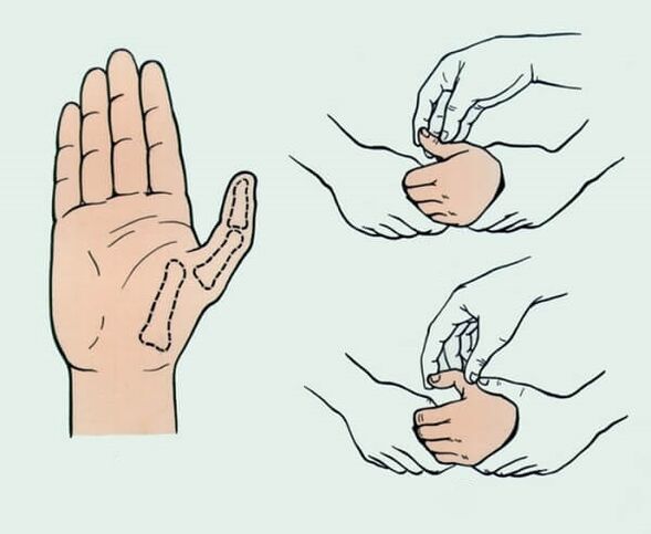 Reducción de un dedo dislocado, necesaria para eliminar el dolor articular.