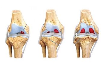 etapas de desarrollo de la artrosis de la articulación de la rodilla