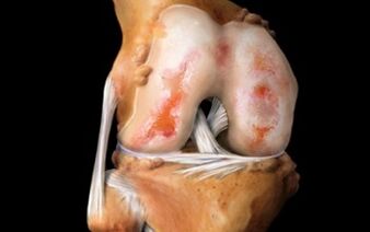 ¿Qué es la artrosis de la articulación de la rodilla