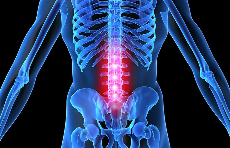 osteocondrosis de la columna lumbar