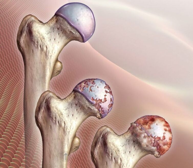 Artrosis de la articulación de la cadera de diversos grados. 