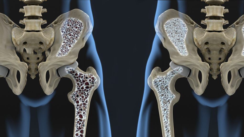 La osteoporosis es la causa de la fractura de cadera y la artrosis de cadera. 