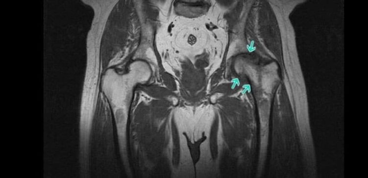 Osteoartritis de la articulación de la cadera en la resonancia magnética