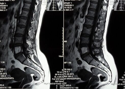 Resonancia magnética de la columna lumbosacra para diagnosticar dolor lumbar