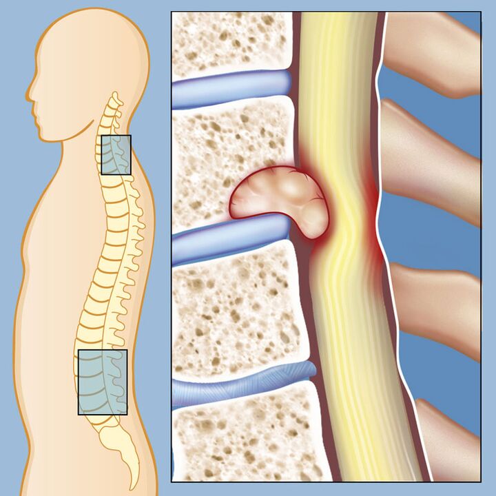 Tumor maligno como causa de dolor lumbar intenso